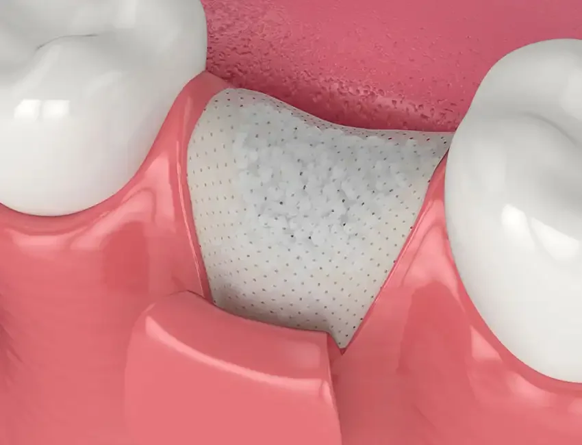 Bone Grafting in Foothill Ranch