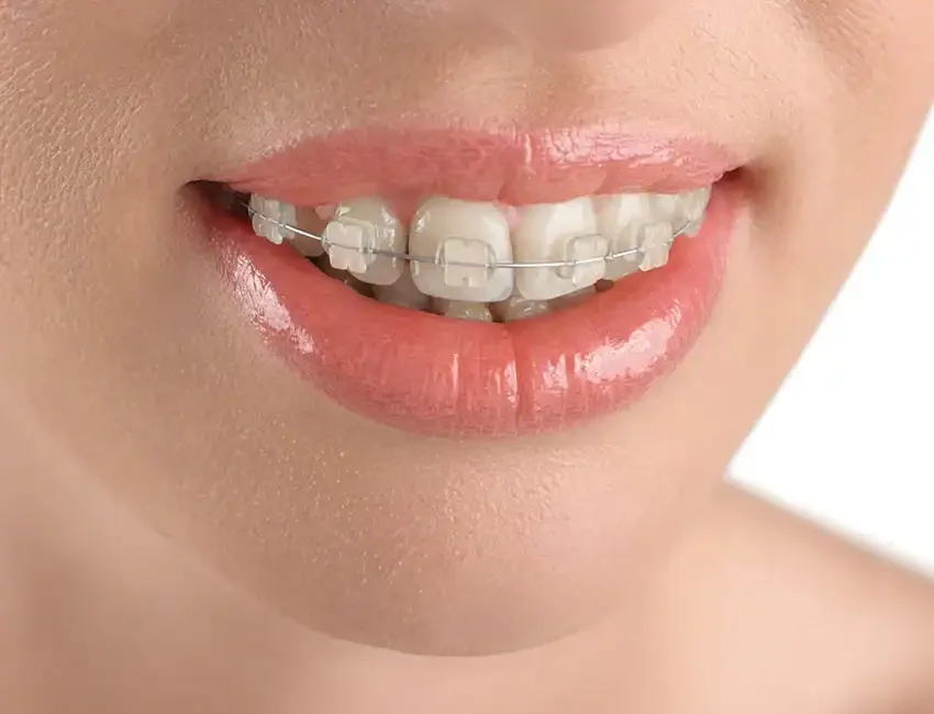Orthodontic braces at Foothill Ranch Dentistry