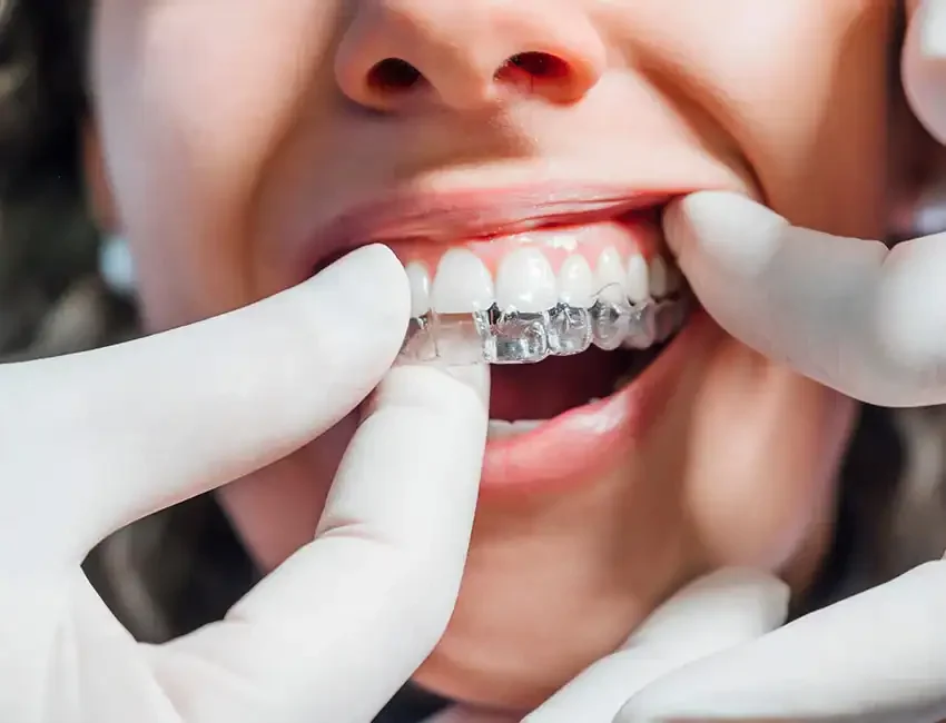 Clear aligners in Foothill Ranch