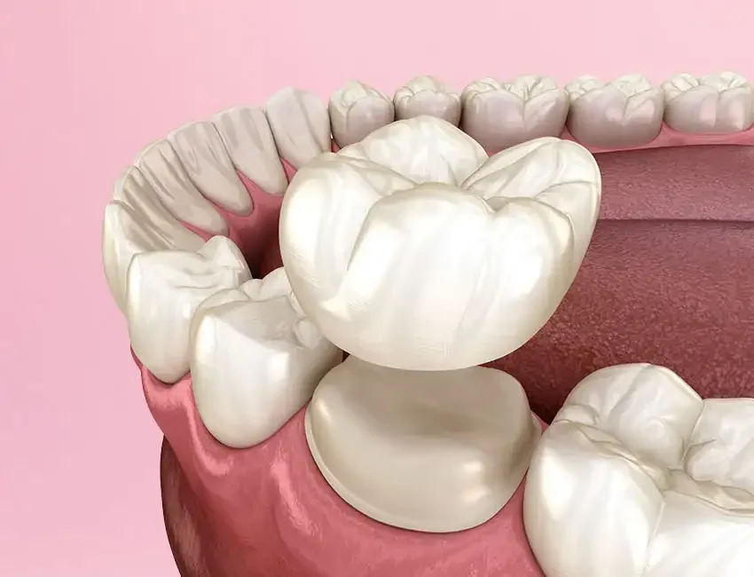 Dental Crown in Foothill Ranch