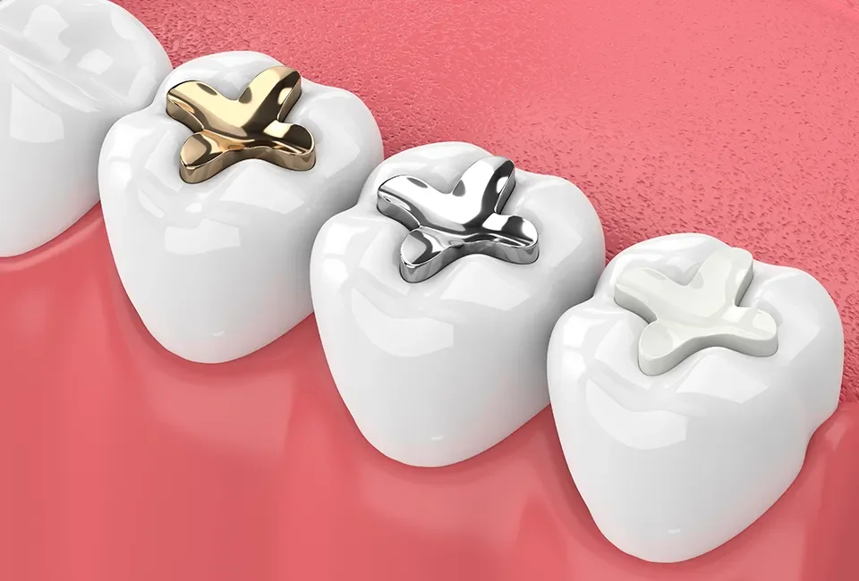 Dental fillings in CA