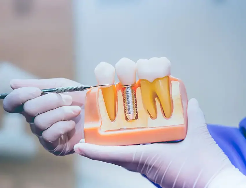 Dental implants in Foothill Ranch