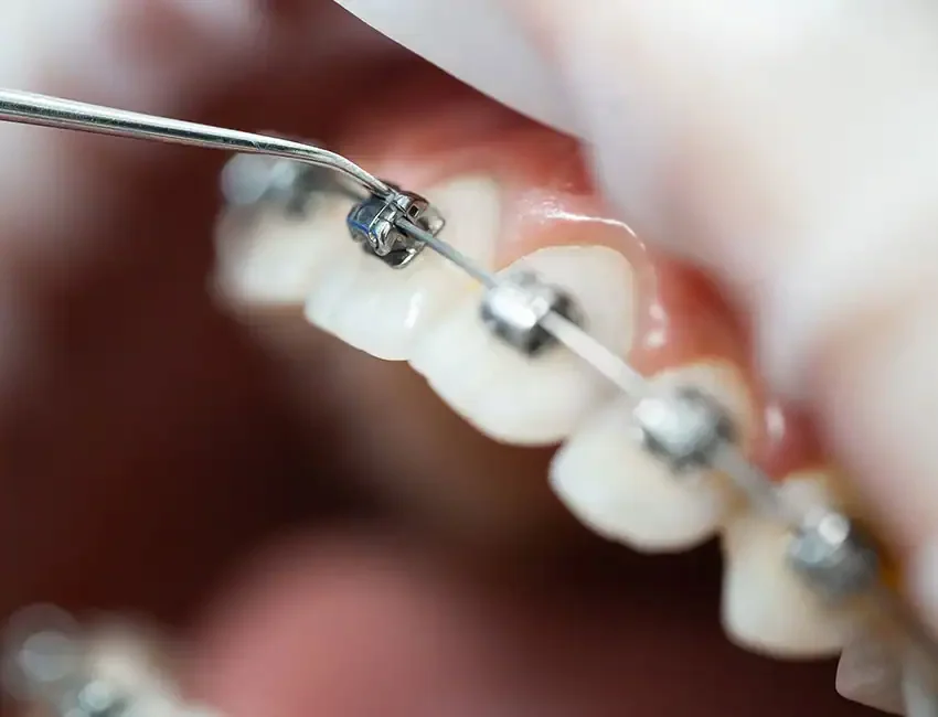 Happy patient with braces in Foothill Ranch, CA