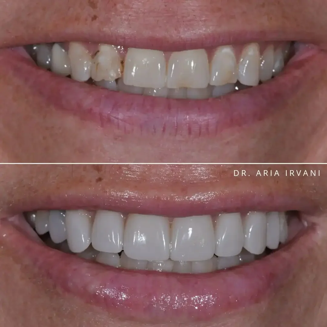 Veneers smile transformation