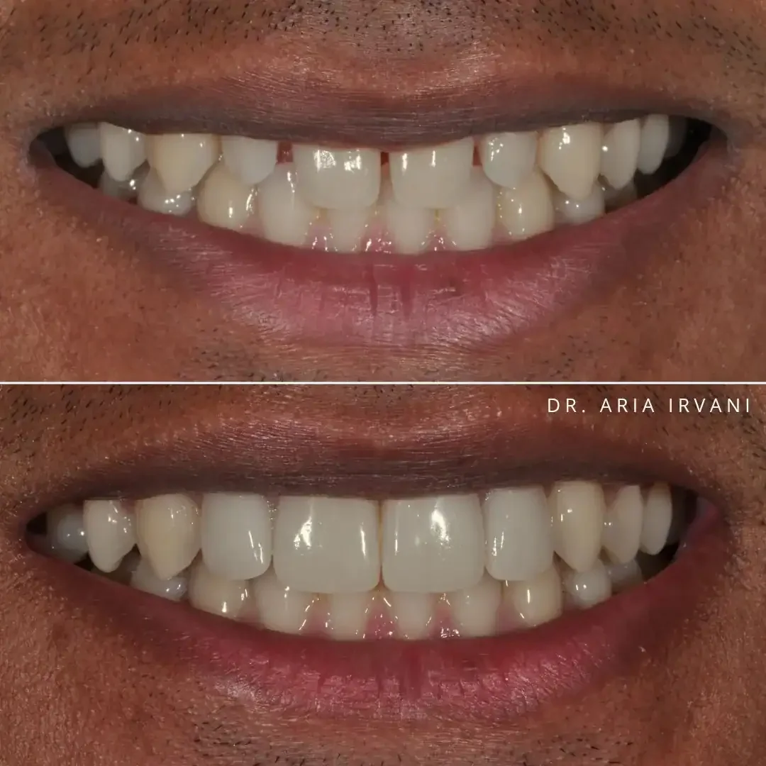 Veneers smile transformation