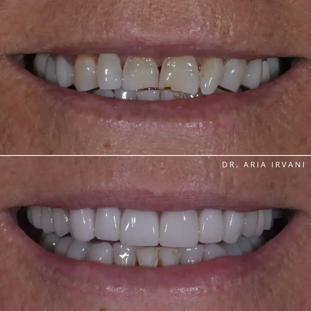Veneers smile transformation