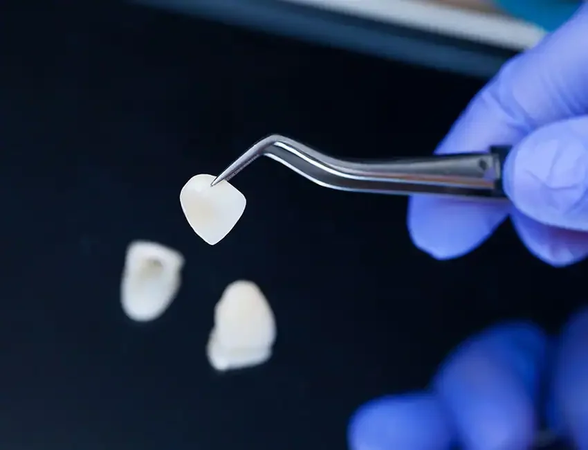 Veneers in Foothill Ranch