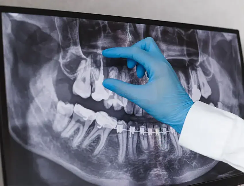 Root canal in Foothill Ranch