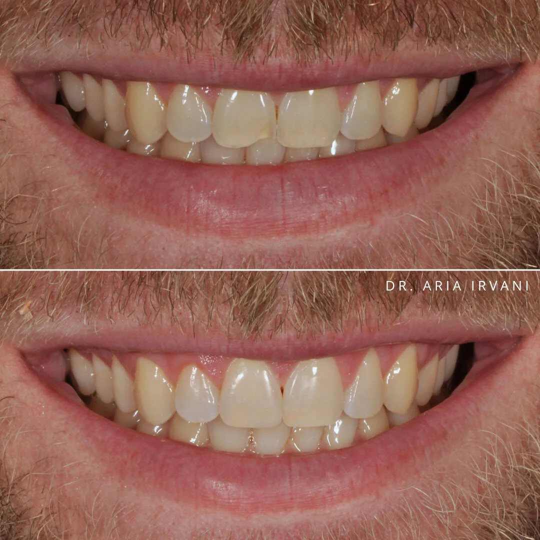 Smile makeover before and after