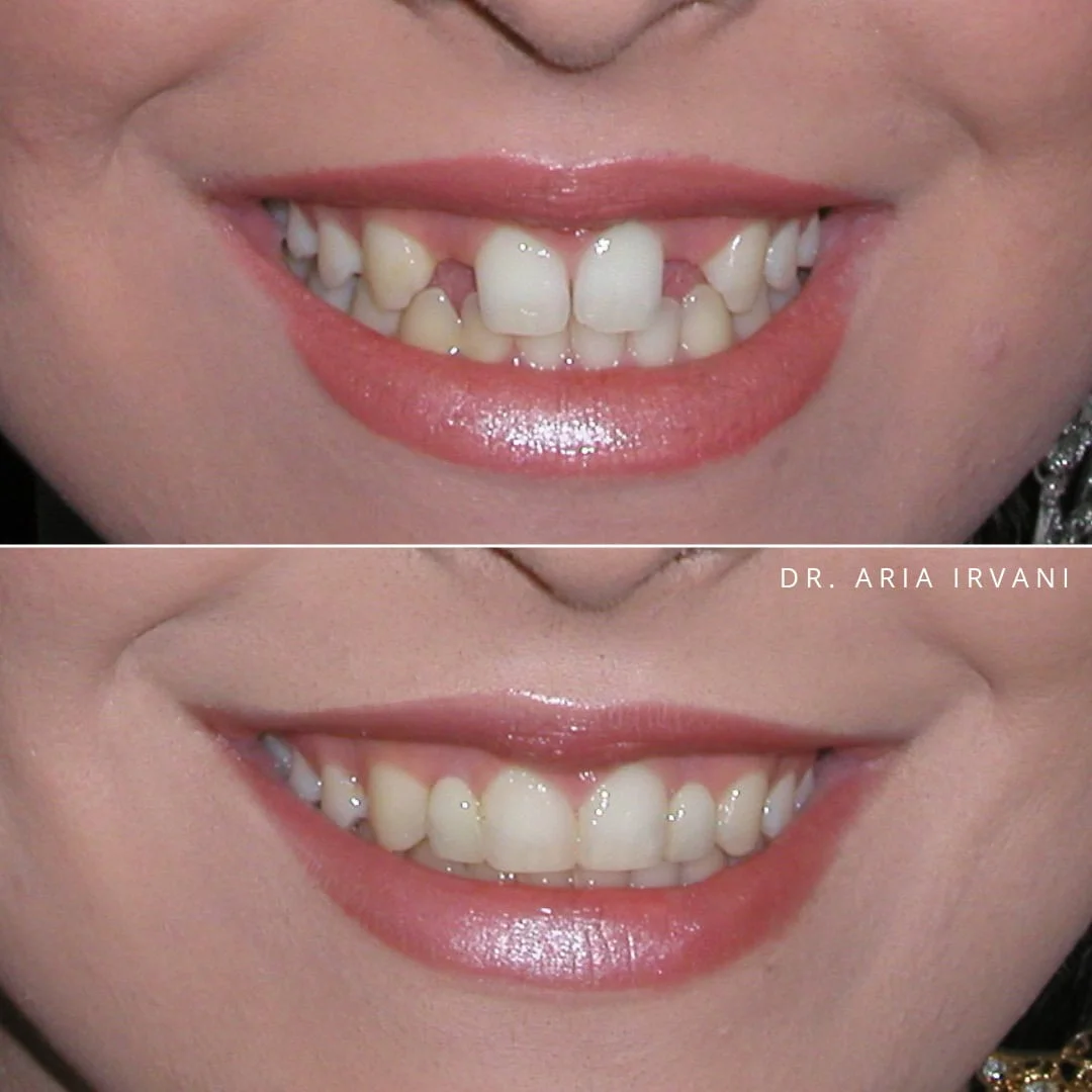 Smile makeover before and after