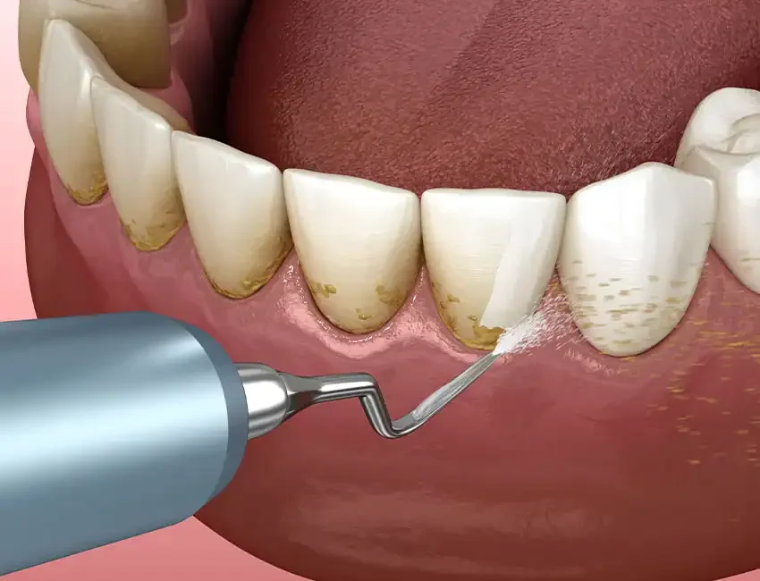 Dental cleaning in Foothill Ranch