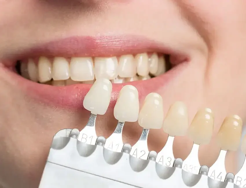 Teeth Whitening in Foothill Ranch