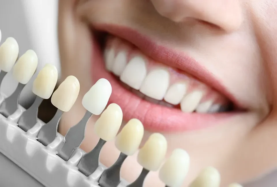 Teeth whitening in CA