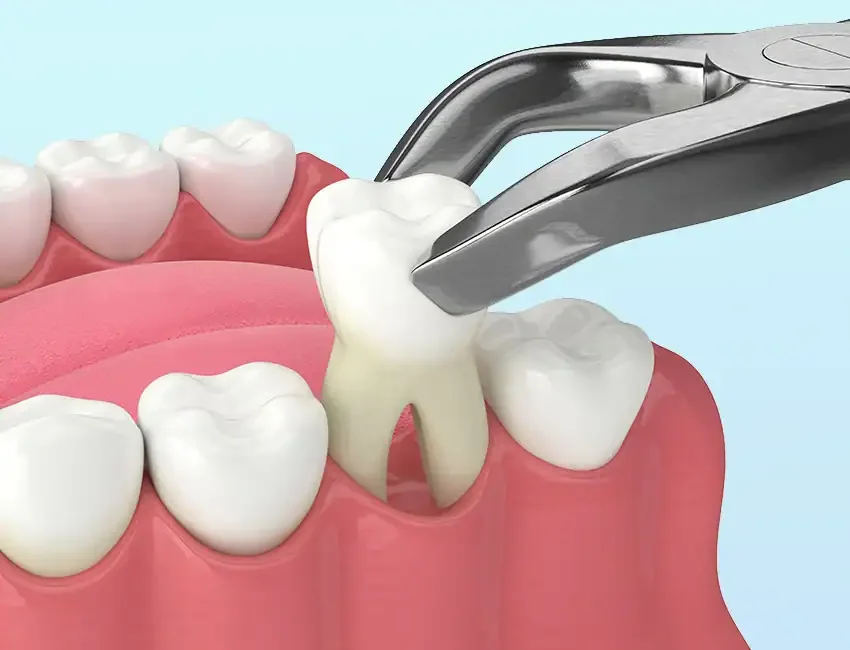 Dental extraction model