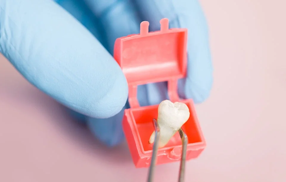 Tooth extraction in CA